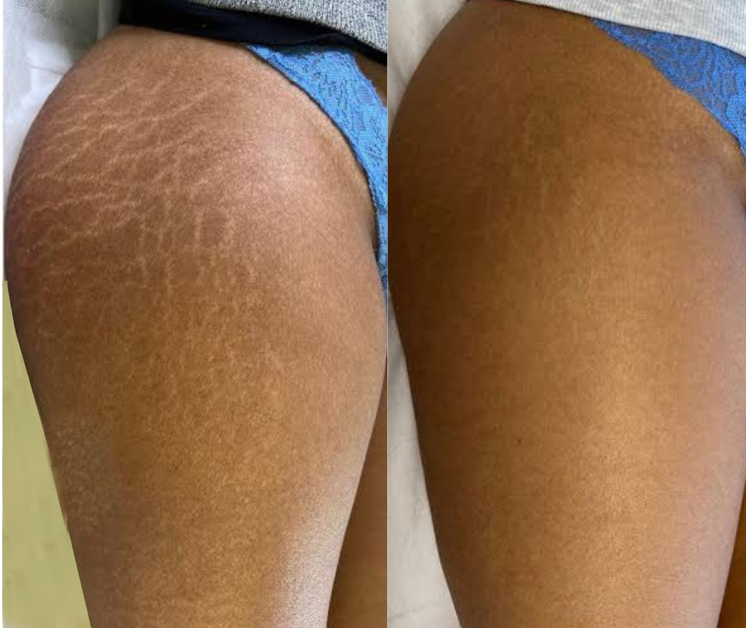 Before After Result 2